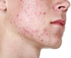 15 home treatments for pimples 1